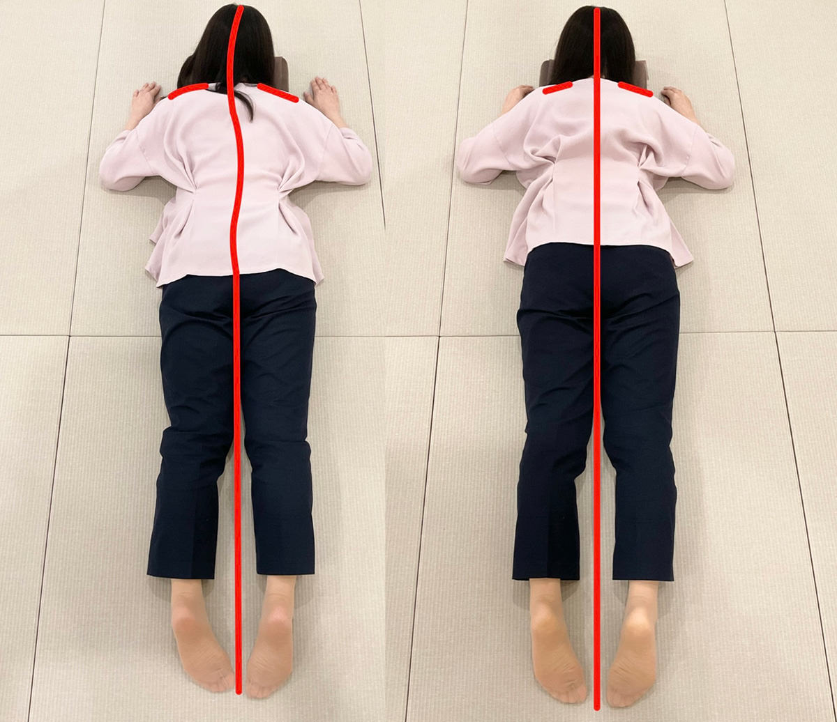 うつ伏せの同じ方を並べた比較写真。左は背骨に沿う線が曲がり肩の高さも左右で違うが、右は線がまっすぐで肩の高さがそろっている