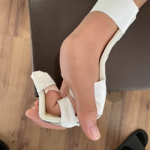 親指と人差し指を曲げた形の副子に沿わせ、テープで留めた手
