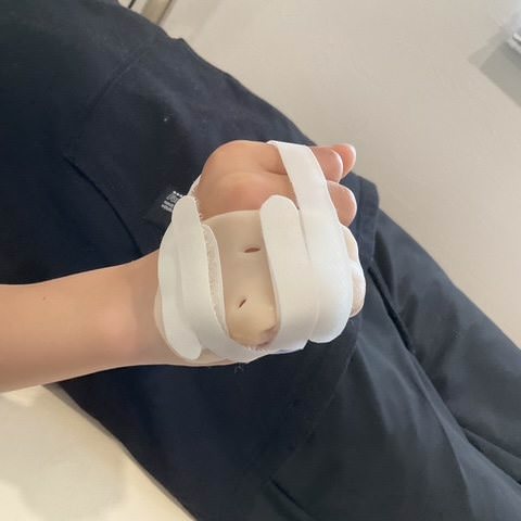 手の甲から指にかけて副子を当て、白いベルトで固定した手